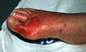 Foot from a diabetic patient showing a superficial ulcer