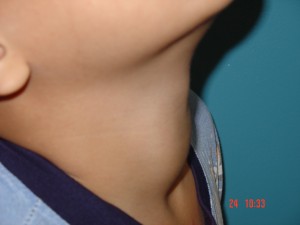 Neck swelling