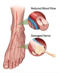Poor circulation (blood flow)